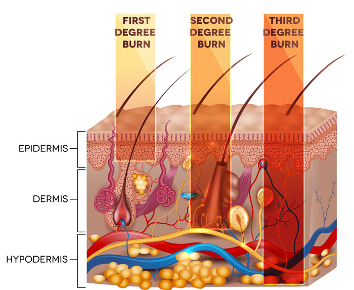 medical diagram showing the extent of burns from the first degree to the third degree