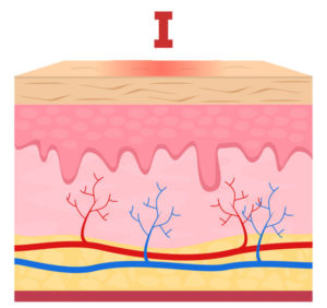 medical illustration of first degree burn