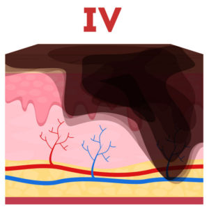 medical illustration of fourth degree burn