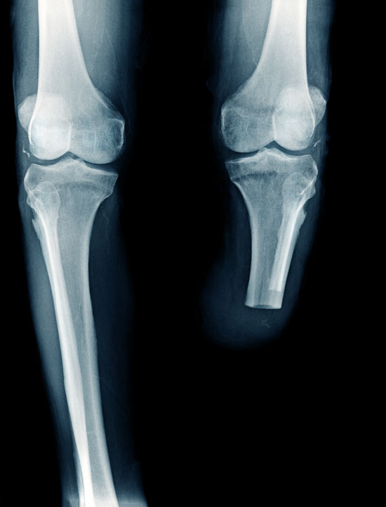 x-ray showing an amputated leg of a person who requires assistance of a Los Angeles amputation injury lawyer