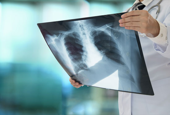 doctor holding x-ray of a patient who was exposed to asbestos and now needs a Los Angeles mesothelioma lawyer