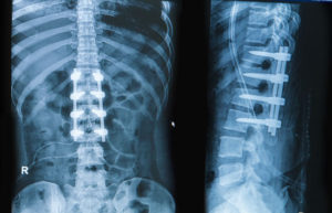 Los Angeles spinal cord injury attorney can assist this person whose x-rays shows a spinal fusion surgery
