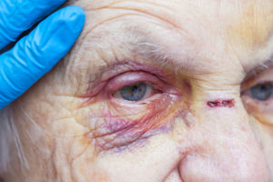 nursing home physical abuse lawyer is ready to help this patient with a hematoma under her eye after being abused