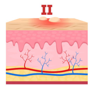 medical illustration of second degree burn