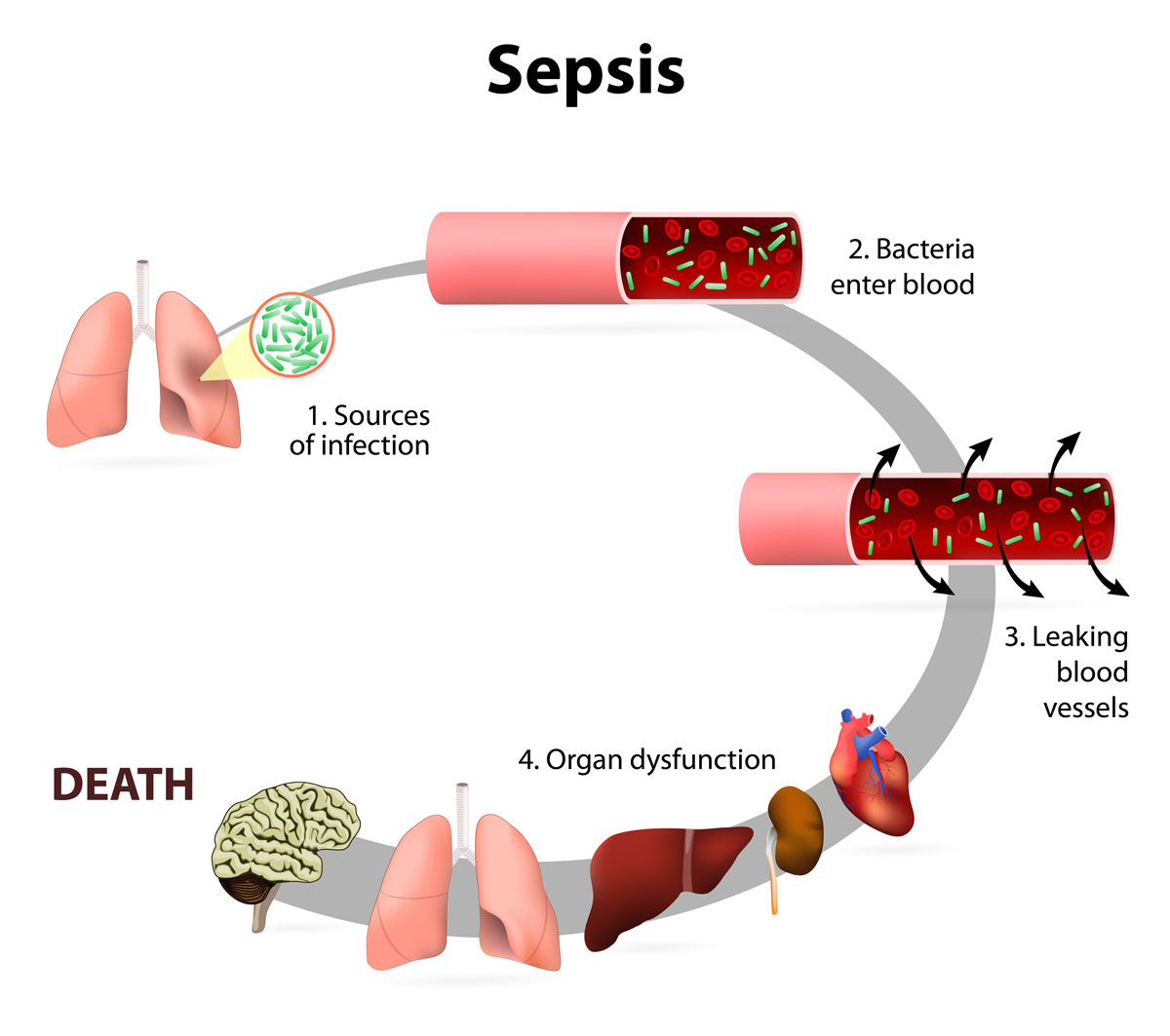 a medical diagram showing progression of sepsis