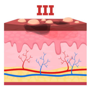 medical illustration of third degree burn