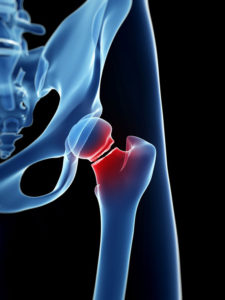 an illustration of x-ray showing a femur fracture is a frequent finding after a fall at a nursing home