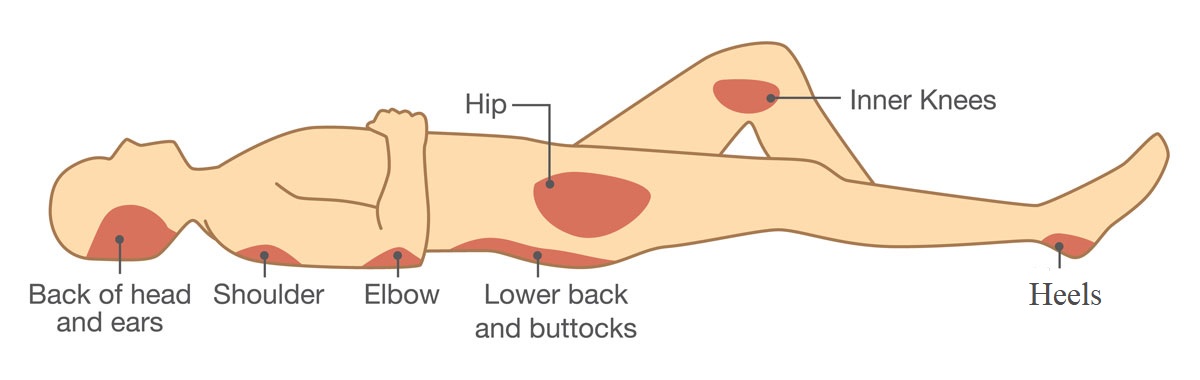 drawing showing typical pressure sores areas on a human body