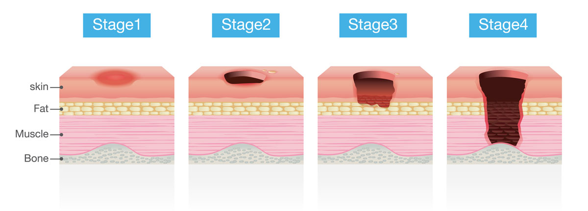diagram demonstrating the stages of pressure sores from stage one through stage four